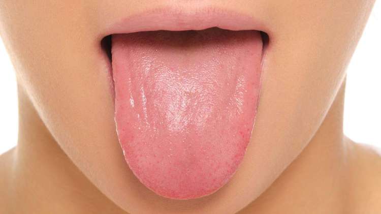 पोलेको जिब्रो कम गराउने घरेलु उपाय