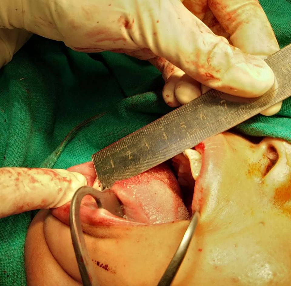 नेपाल मेडिकल कलेजले खोलिदियो बन्द भएको मुख