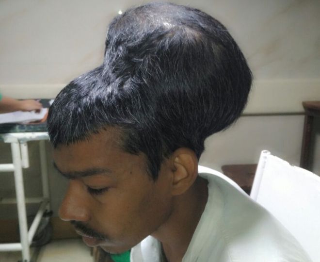 भारतीय डाक्टरहरुद्वारा विश्वकै सबैभन्दा ठूलो मस्तिष्क ट्युमरको सफल शल्यक्रिया