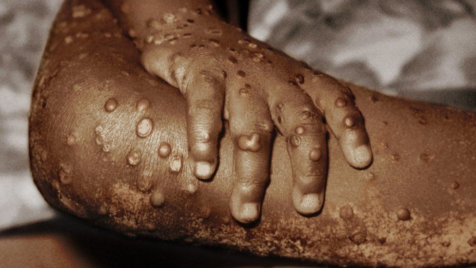 Monkeypox declared notifiable disease in Britain