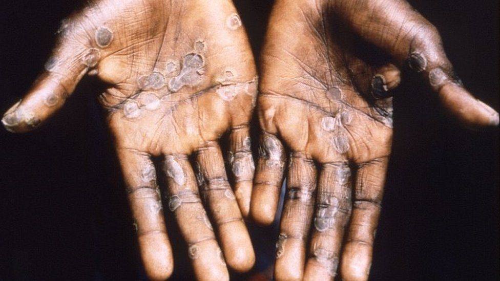 World faces big challenges over Covid, monkeypox and wars - WHO