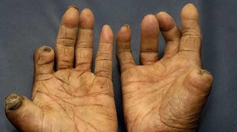 Jhapa struggling with leprosy patients