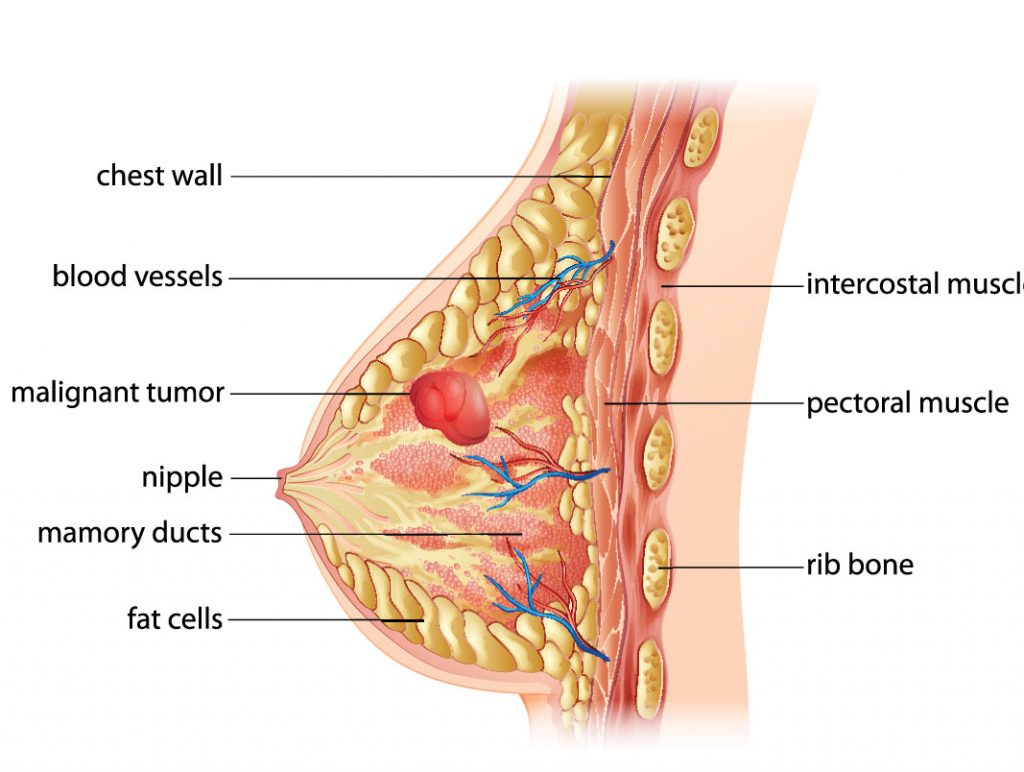 Free breast cancer treatment