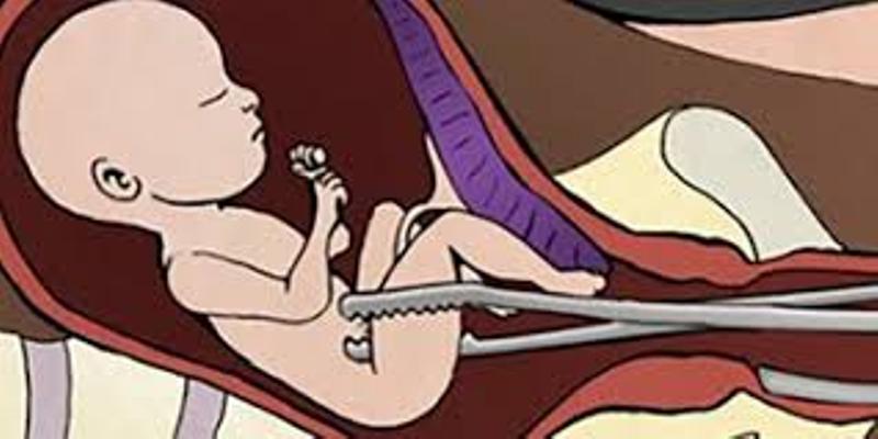 Unsafe abortion: 13-year-old girl’s life hangs by thread in Banke