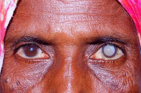 Dang records over 500 cataract patients
