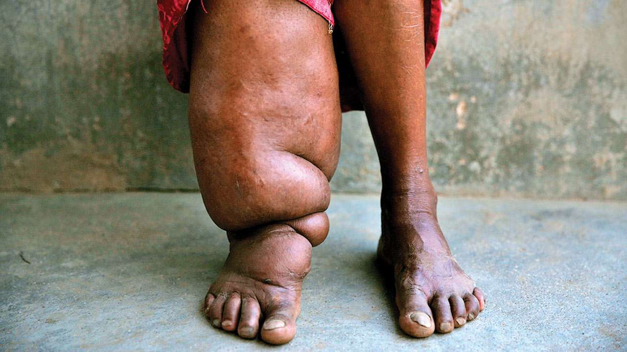 Government administering anti-elephantiasis drugs to people in 12 districts