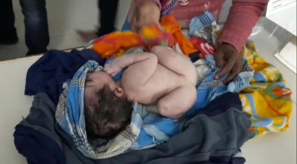भारतमा तीन हात, तीन खुट्टा भएको बच्चा जन्मियो