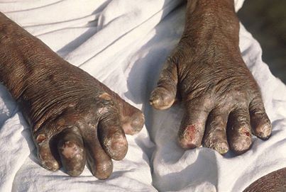 79 new leprosy patients found in Siraha