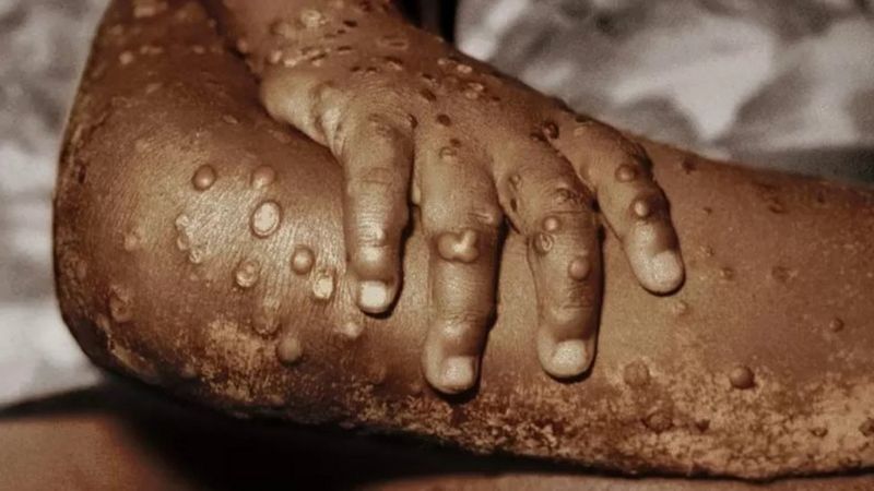 Mpox virus detected in Pakistan, health authorities say