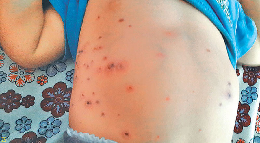 Adolescent girl dies of scrub typhus