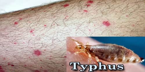 Scrub typhus and dengue patients on the rise