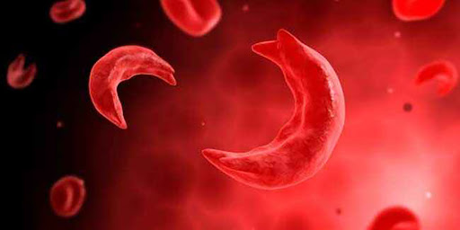 Flow of sickle cell anemia patients increasing at Bheri Hospital