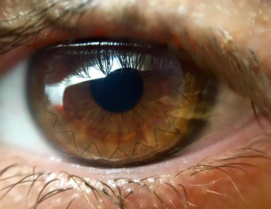 'Let us spread vision,' say people who have got sight after corneal transplant