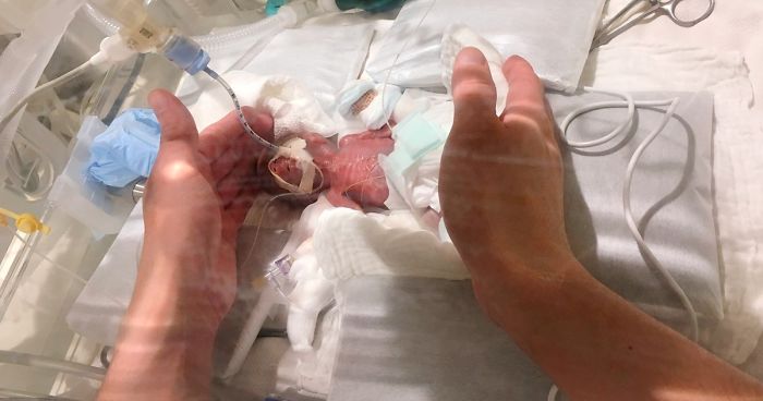 अनौठो घटनाः स्याउजत्रो आकारको बालक, अस्पतालबाट डिस्चार्ज गर्ने तयारी